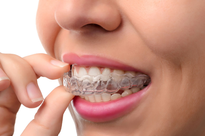 Invisalign Aligners